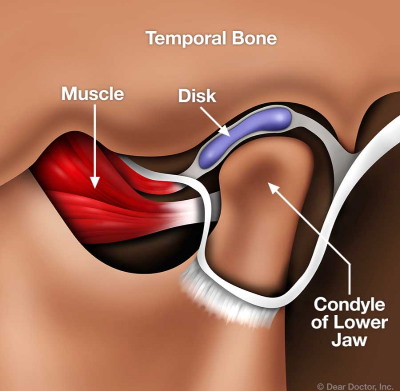 Diagram Shows Causes Of Tmd at Meadville Pennsylvania