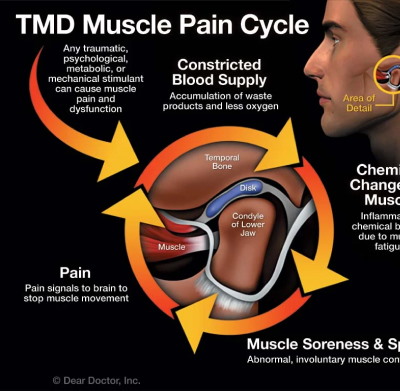 Diagram Shows Muscle Pain Cycle at Meadville Pennsylvania