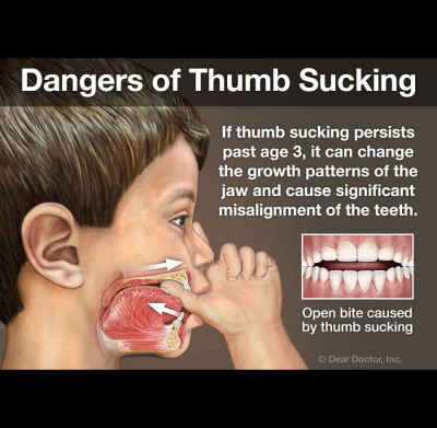 Effects Of Thumb Sucking On Teeth Alignment at Meadville Pennsylvania