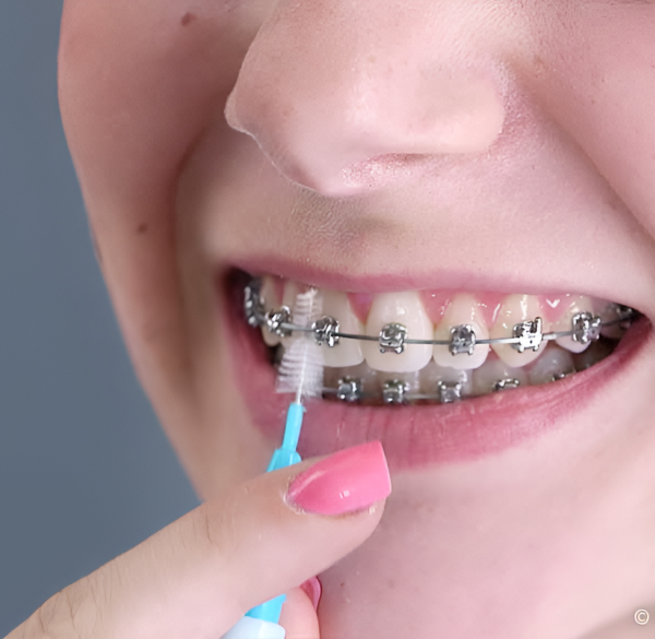 Woman With Braces Is Diligently Brushing Her Teeth at Dr Shok Office Meadville Pennsylvania