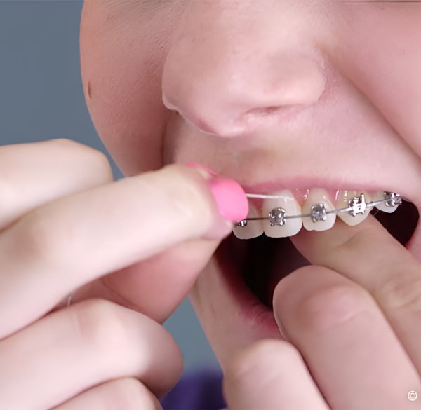 Young Girl With Braces at Dr Shok Office Meadville Pennsylvania