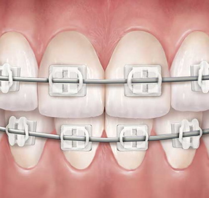 Clear Braces Treatment at Meadville Pennsylvania