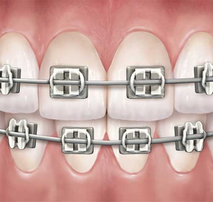 Metal Braces Treatment at Meadville Pennsylvania