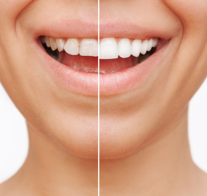 Woman Showcasing Her Bright White Teeth Before And After at Meadville Pennsylvania