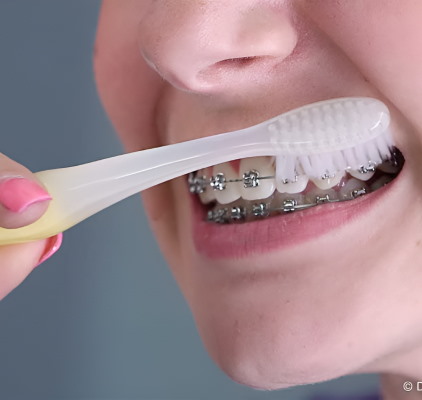 Woman With Braces Is Brushing Her Teeth at Meadville Pennsylvania