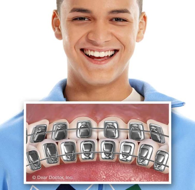 Lingual Braces at Dr Shok Office Meadville Pennsylvania