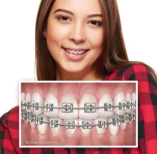 Metal Braces at Dr Shok Office Meadville Pennsylvania