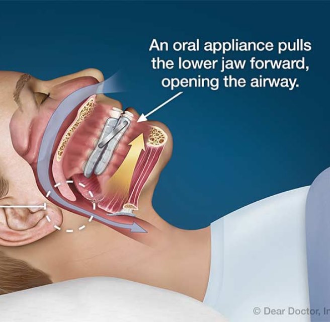 Oral Device That Pulls The Jaw Forward At Dr Shok Office Meadville Pennsylvania